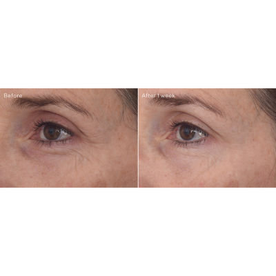 Murad Retinal Resculpt Eye Lift Treatment Hamilton Place