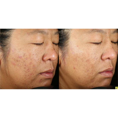 Murad Invisiscar Resurfacing Treatment