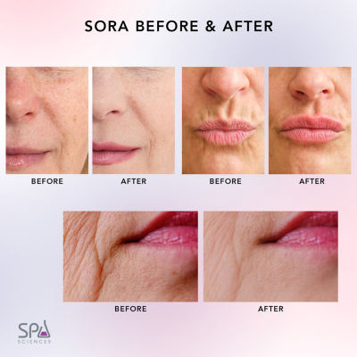 Spa Sciences Sora  Microneedling Derma Tool