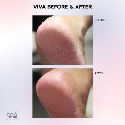 Spa Sciences Viva Advanced Pedicure Foot Smoothing System